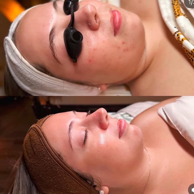 Bi-weekly chemical peels at Beautyberry Aesthetics in Austin, TX